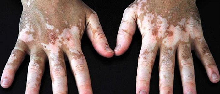 शरीरमा सेतो दाग किन देखिन्छ र कसरी हटाउने ? (उपायसहित)